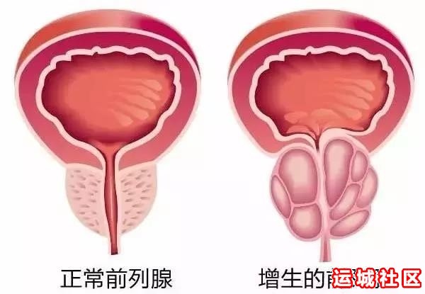 前列腺增生症何时手术最佳